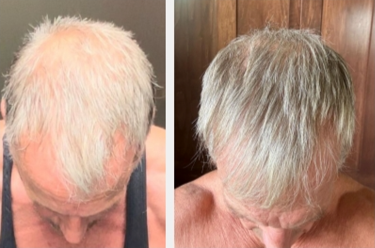 Can Hair Greying Be Reversed? Exploring Early Findings Behind NutriRoot.co’s Side Benefits